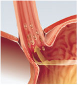 Karın Ağrısı Reflü Hastalığı