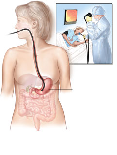 çocuk Reflü Hastalığı