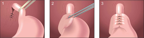 Nissen fundoplikasyon tekniği Reflü Hastalığı